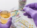 Urinprobe mit Teststreifen zur Analyse. Mögliche erhöhte Leukocyten im Urin werden durch Farbveränderungen auf dem Teststreifen angezeigt.