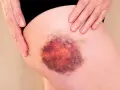 Große, dunkle blaue Flecken auf der Haut des Oberschenkels, die von einer Hand berührt werden.