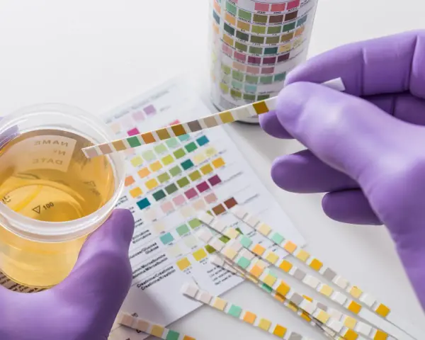 Urinprobe mit Teststreifen zur Analyse. Mögliche erhöhte Leukocyten im Urin werden durch Farbveränderungen auf dem Teststreifen angezeigt.