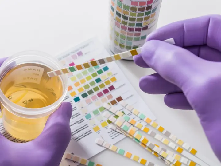 Urinprobe mit Teststreifen zur Analyse. Mögliche erhöhte Leukocyten im Urin werden durch Farbveränderungen auf dem Teststreifen angezeigt.