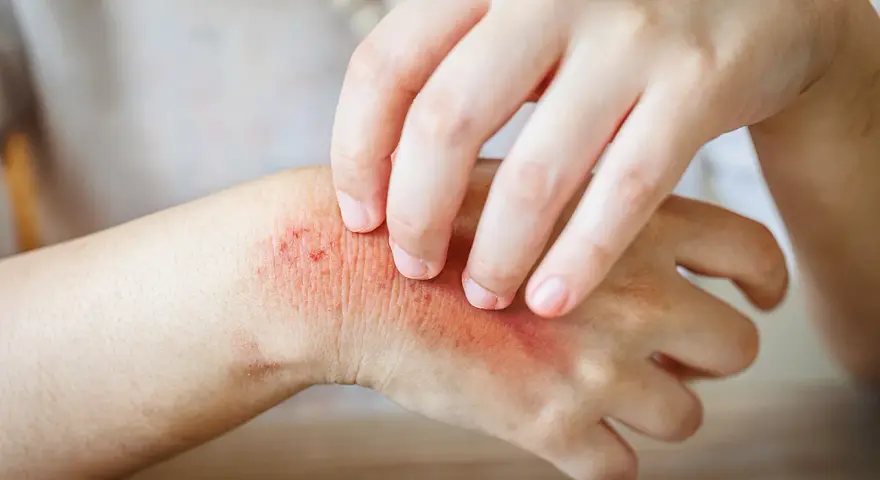Juckende Haut: Ein Ekzem an der Hand, das durch Kratzen verschlimmert wird.