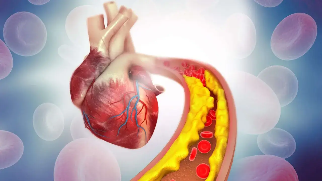 Herz mit Arterienverkalkung. Gelbe Ablagerungen verengen das Blutgef&auml;&szlig;, was die Lebenserwartung bei Arteriosklerose beeinflusst. Rote Blutk&ouml;rperchen k&auml;mpfen sich durch.