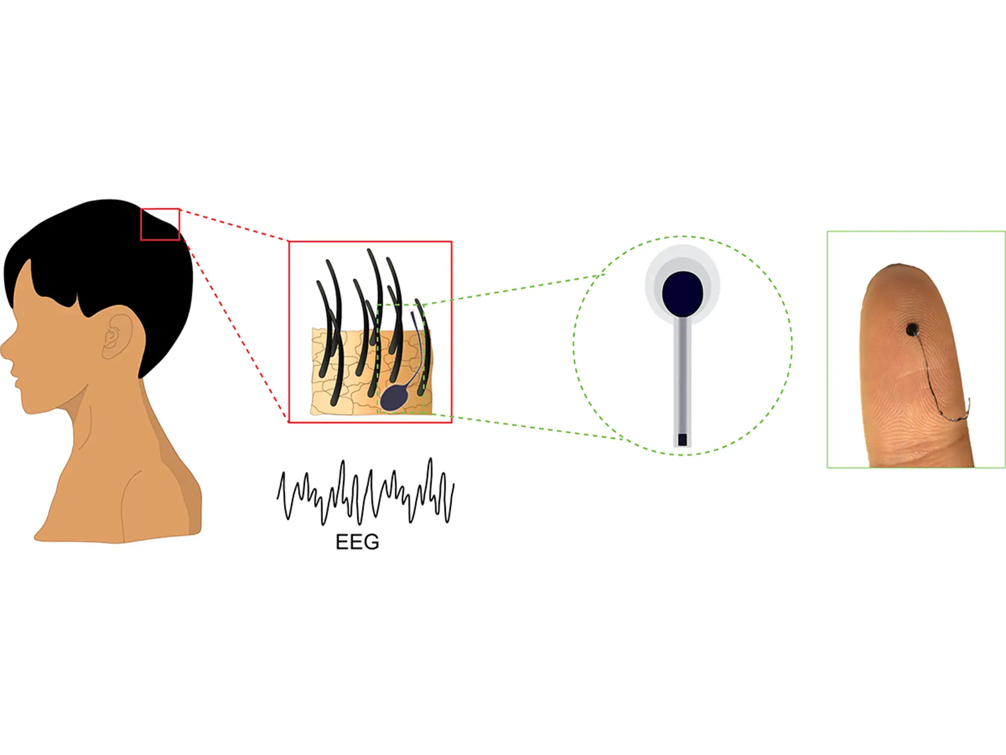 Illustration zeigt eine eeg untersuchung. Ein winziger Sensor wird an einem Haar befestigt, um Gehirnaktivit&auml;t zu messen.