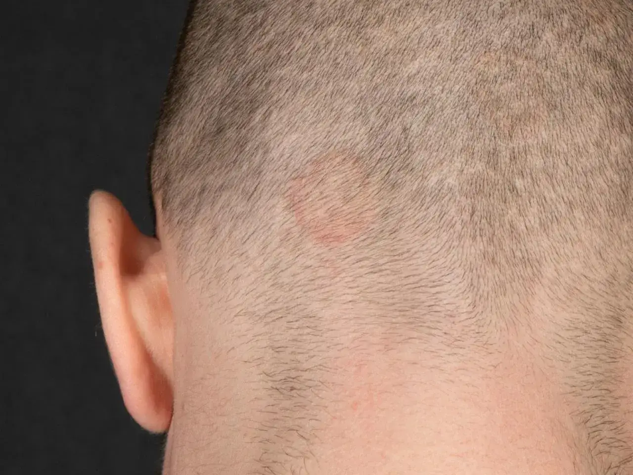 Rötlicher, ringförmiger Hautausschlag am behaarten Kopf, möglicherweise tinea corporis.