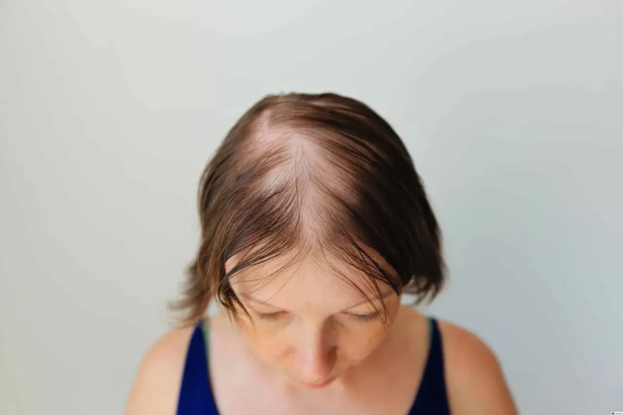 Kopf einer Frau mit sichtbaren Geheimratsecken und dünner werdendem Haar, was auf diffusen Haarausfall hindeutet.