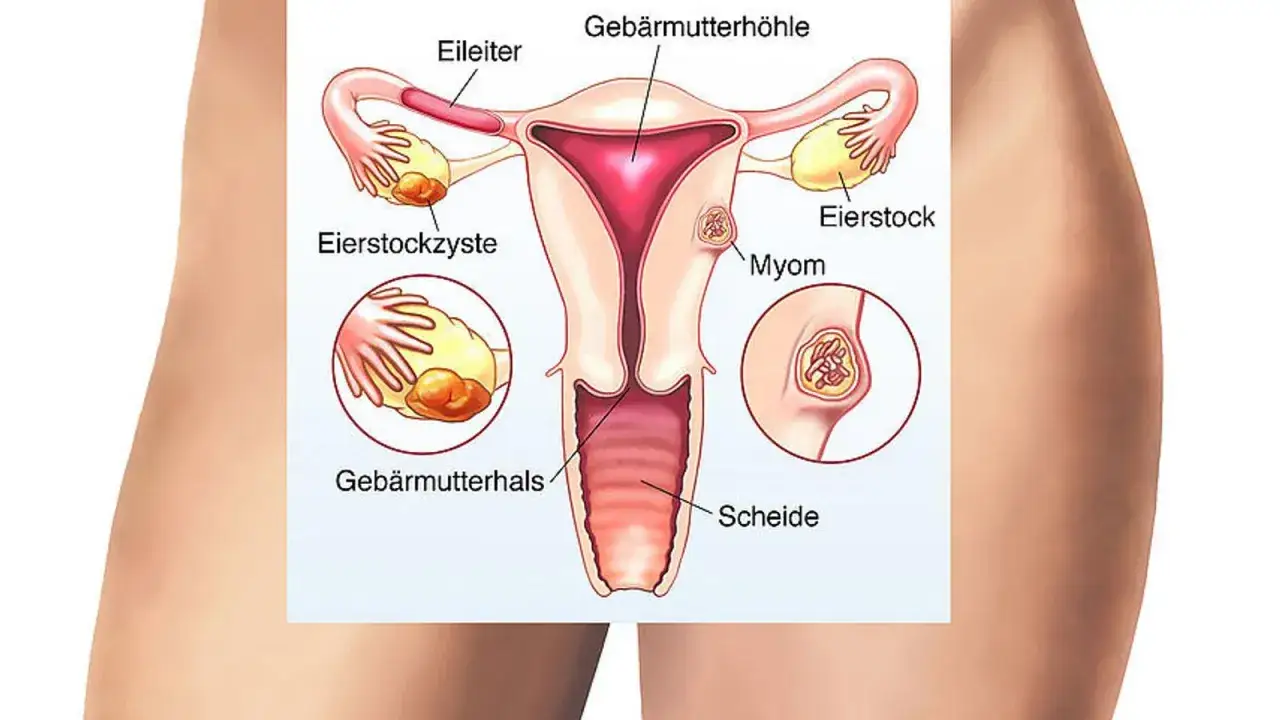 Anatomie des weiblichen Unterleibs mit Gebärmutter, Eierstöcken, Eileitern und Scheide. Mögliche Ursachen für unterleibsschmerzen ohne periode: Eierstockzyste, Myom.