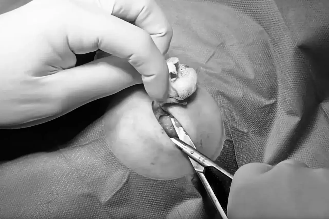 Chirurgische Entfernung eines Lipoms. Hände in Handschuhen halten Instrumente, um das Lipom zu entfernen.