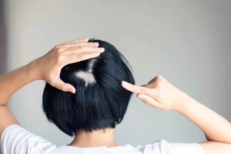 Eine Frau entdeckt kreisrunden Haarausfall am Hinterkopf. Ihre Hände berühren die kahle Stelle, die sich deutlich vom dunklen Haar abhebt.